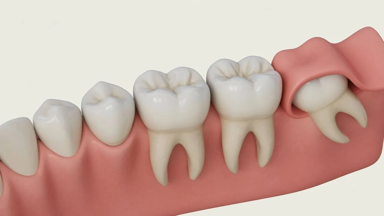 Three anaesthetic options for wisdom teeth removal: local anaesthetic, conscious sedation and general anaesthetic.