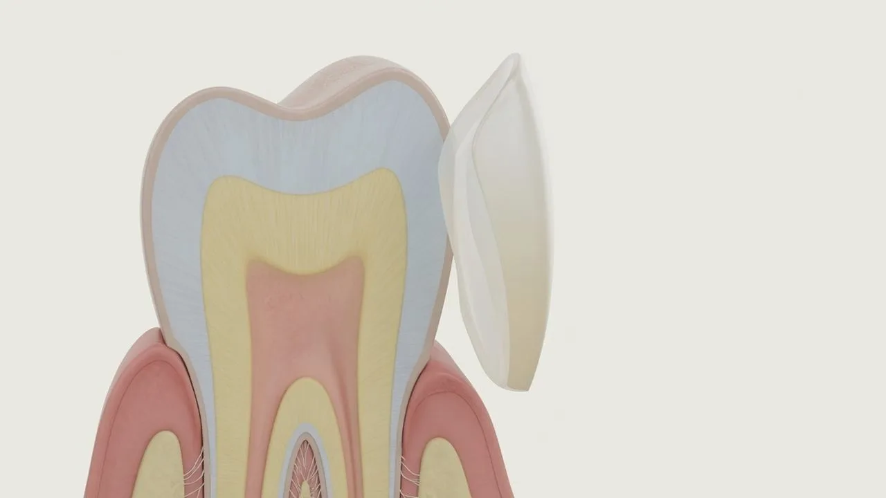 Three-step porcelain veneer preparation sequence: impression taken, tooth trimmed and veneer prepared.