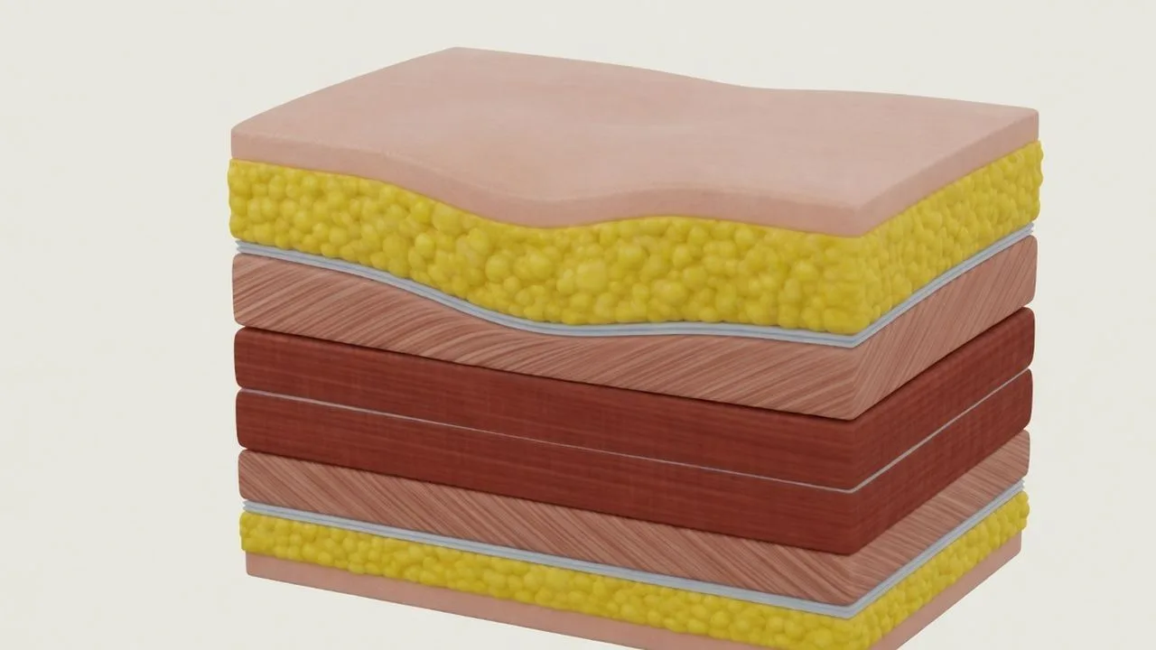 Three-step liposuction sequence: infusion, controlled motion and suction.